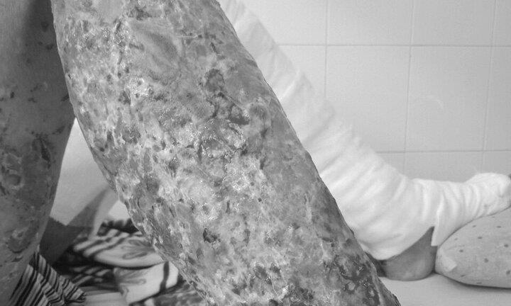 Vợ vừa mất, người thợ hồ lở loét tứ chi nguy kịch do nhiễm não mô cầu