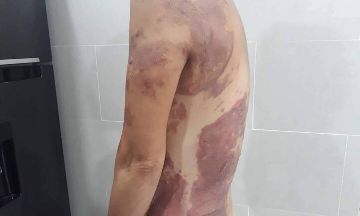 Nhắc nhở hàng xóm đậu ô tô trước cửa nhà, một phụ nữ bị tạt dầu sôi vào người