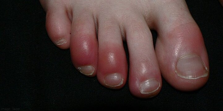 Mách nhỏ mẹo chữa bệnh cước tay chân vào mùa đông rét đậm, rét hại