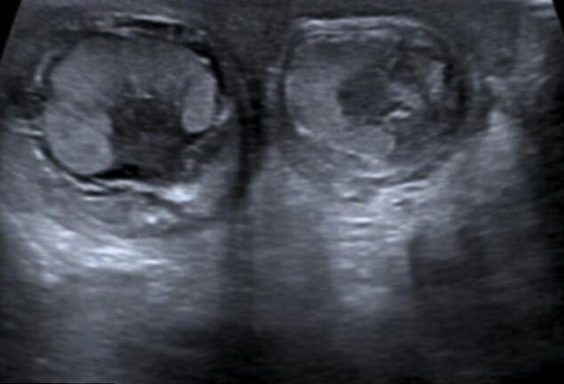 Cậu bé bị xoắn cả hai tinh hoàn trong bụng mẹ