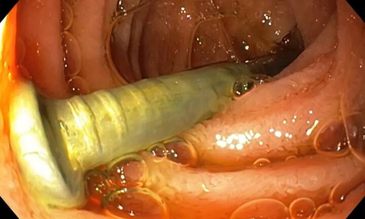 Bé trai suýt mất mạng vì nuốt phải chiếc đinh dài 3 cm