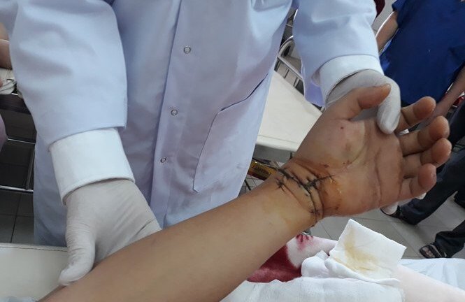 Bảo quản trong đá lạnh, bàn tay trái bị đứt lìa được ghép nối thành công