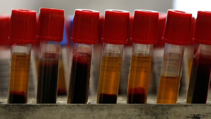 Xét nghiệm máu và nước tiểu có thể phát hiện chứng tự kỷ ở trẻ em