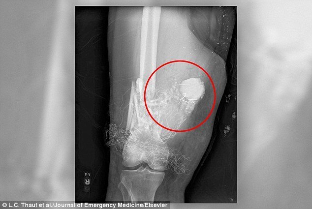 Bác sĩ nhờ đội phá bom gỡ pháo hoa chưa nổ mắc kẹt trong đùi bệnh nhân