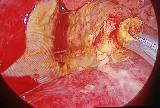 Thủng ruột non, chảy mủ trong ổ bụng vì nuốt phải thứ quen thuộc này