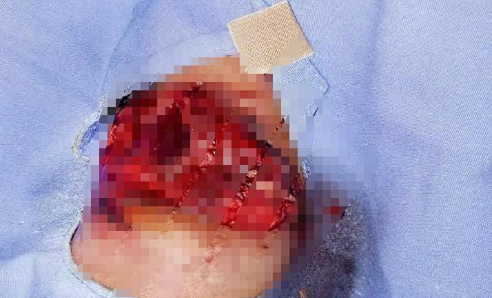 Bé gái 13 tuổi dập phổi, nát cánh tay do pháo nổ