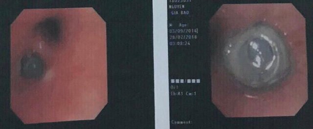 Khám viêm phổi, phát hiện viên đạn trong phế quản bé trai 3 tuổi ở Đắk Lắk