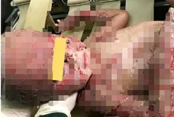 Cha hiến da ghép cho con bị bỏng nặng nguy cơ chết vì nhiễm trùng, nhiễm độc