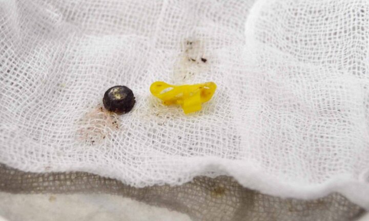 Mắc pin, dây buộc tóc trong mũi, bệnh nhi suýt thủng vách ngăn