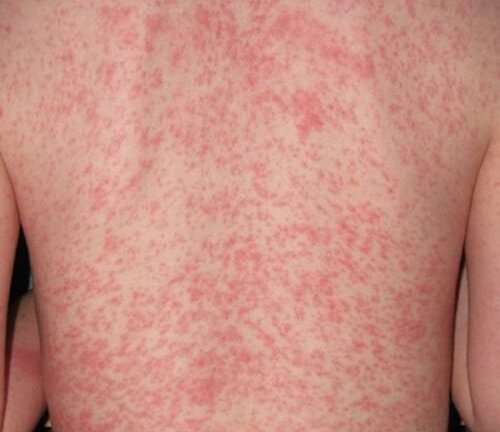 Hà Nội: Số ca mắc bệnh sởi ngày càng gia tăng