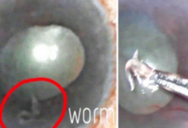 Rùng rợn hình ảnh ký sinh trùng sống trong mắt người phụ nữ Ấn Độ