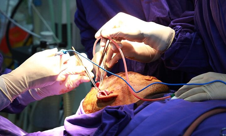 Hãi hùng cảnh gắp gần 100 dị vật ở vùng hàm mặt bệnh nhân 43 tuổi