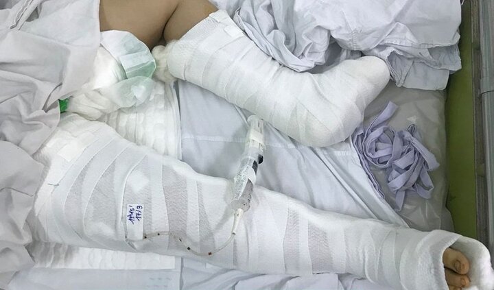 Xót thương bé gái ngã từ tầng 3 xuống đất gãy xương nhiều bộ phận