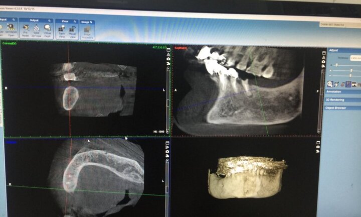 Hy hữu: Cấy ghép răng cho cụ bà 91 tuổi với nhiều bệnh lý phức tạp