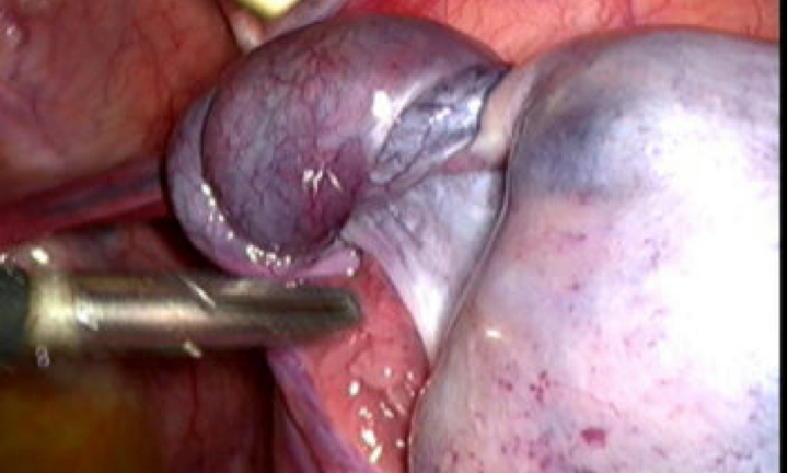 Cấp cứu tưởng đau ruột thừa, ai ngờ bé gái 10 tuổi bị u buồng trứng xoắn