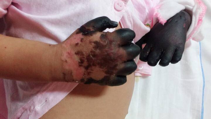 Xót thương bé gái bị hoại tử tứ chi do mắc bệnh hiếm gặp