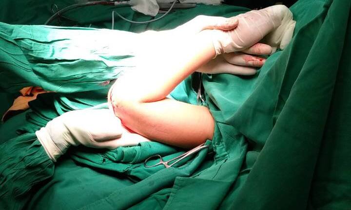 Gãy tay đi bó thuốc 'lang băm', bé trai biến chứng hoại tử cứng khớp