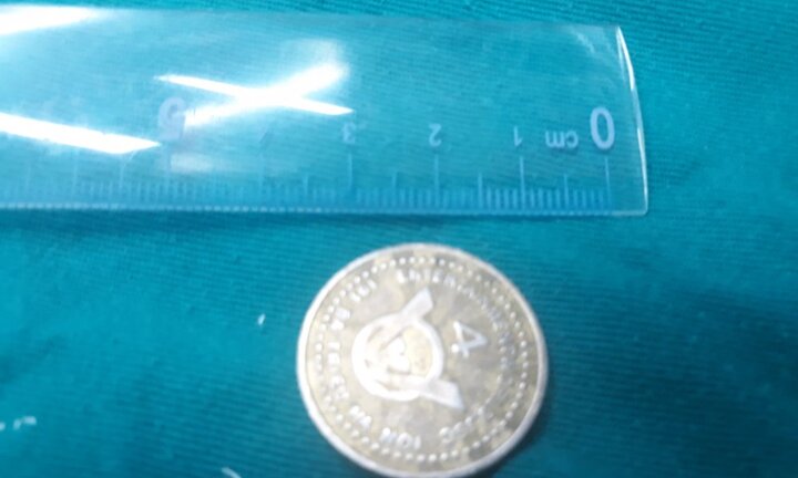 Bé 7 tuổi bị mắc kẹt đồng xu giữa cổ họng