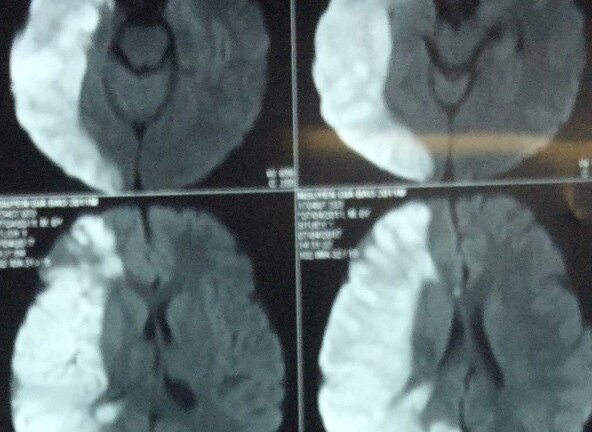 Hai trẻ bị đau đầu bất thường mắc bệnh máu não hiếm gặp