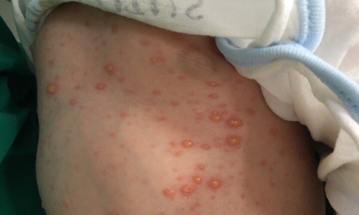 Mẹ bầu không tiêm phòng vắc xin, bé trai 10 ngày tuổi mắc thuỷ đậu