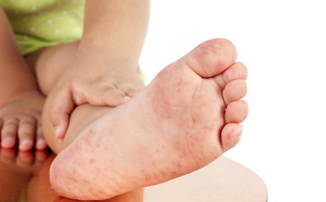 Chăm sóc trẻ bệnh tay chân miệng tại nhà: Những điều phụ huynh cần lưu ý