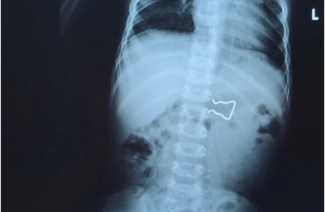 Hi hữu: Phát hiện đoạn dây inox sắc nhọn trong bụng bé trai 18 tháng