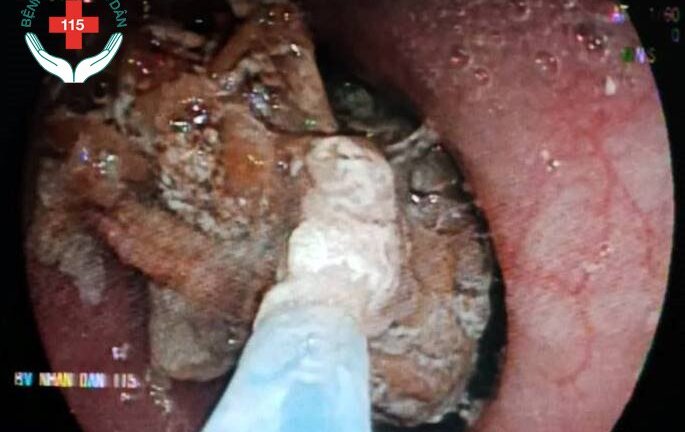 Miếng gân bò 'nằm lì' trong thực quản cụ ông 88 tuổi