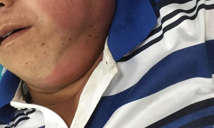 Tự mua thuốc chữa viêm họng, bệnh nhân nhiễm trùng máu, biến dạng khuôn mặt