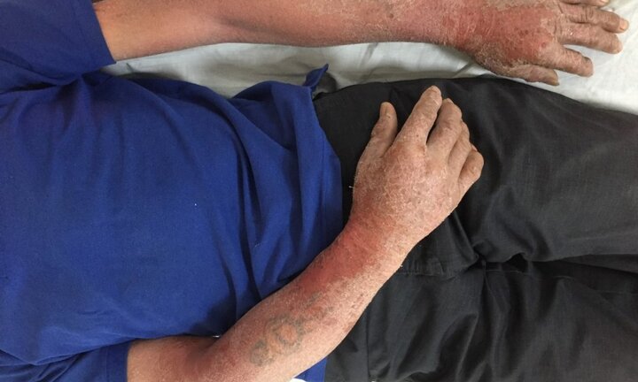 Ngứa, bong tróc da toàn thân có rỉ nước vàng do đi cắt cỏ cho trâu