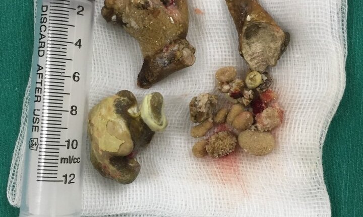 Viên sỏi to như củ gừng nằm trong thận nam bệnh nhân suốt 3 năm