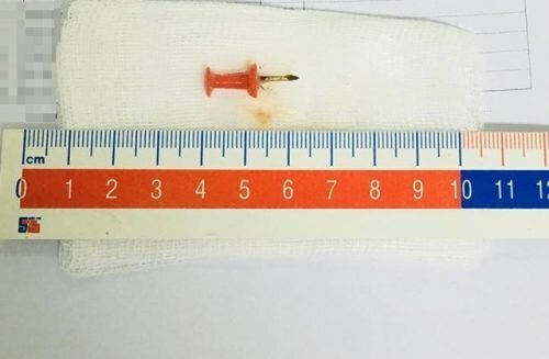 Bé gái 12 tuổi ho ra máu vì chiếc đinh ghim giấy ghim trong phế quản