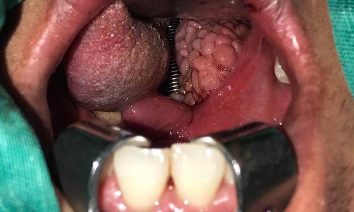 Khủng khiếp amidal sần sùi, nổi cục như chùm nho chèn kín đường thở