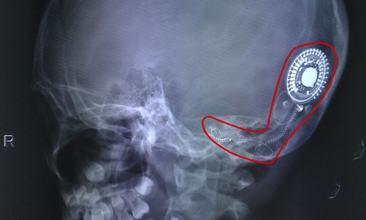 Hơn 7 năm câm điếc, bé gái ở Đồng Nai lần đầu được nghe âm thanh của cuộc sống