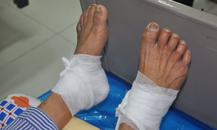 Chườm nóng bằng lá ngải cứu giúp giảm chứng tê bì chân, người đàn ông 60 tuổi bỏng nặng