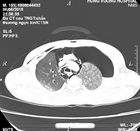 Cái kết đắng với thanh niên 18 tuổi uống rượu say, ngã đập ngực tràn dịch phổi
