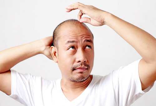 Bất ngờ 5 nguyên nhân gây hói đầu ở nam giới