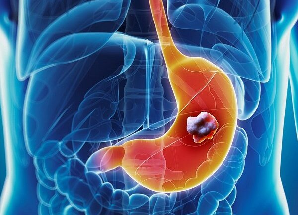 6 dấu hiệu không hề đau đớn nhưng cảnh báo ung thư dạ dày