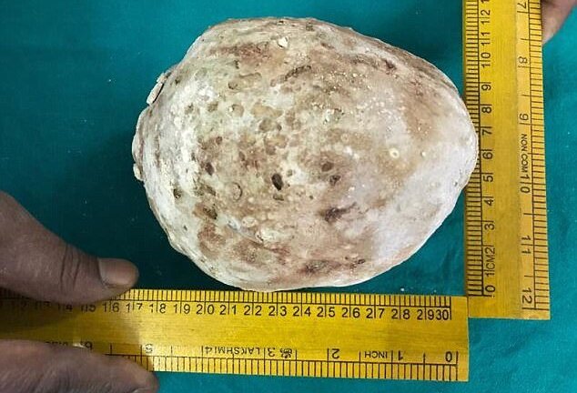 Bác sỹ vật lộn hàng tiếng đồng hồ lấy viên sỏi thận to như quả bưởi