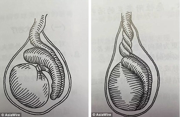 Xoắn tinh hoàn khi ngủ, cẩn thận mất cơ hội làm bố