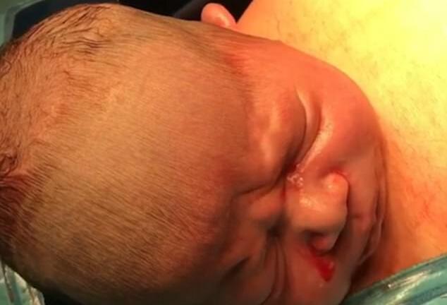 Video: Bác sĩ rạch bụng mẹ, em bé tự chui ra đầy kinh ngạc