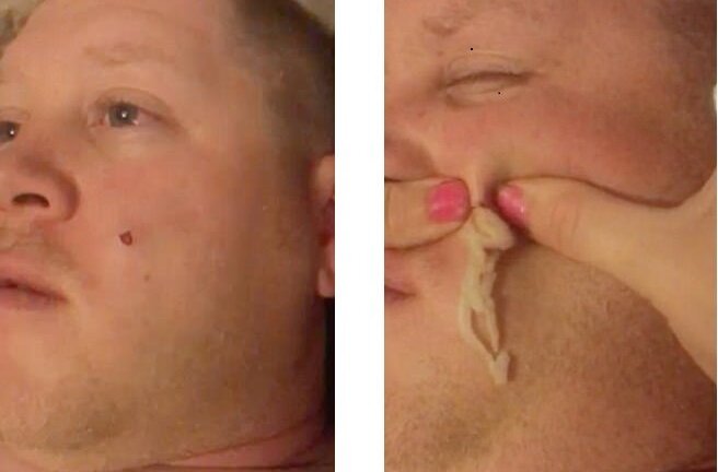 Video: Rùng mình cảnh vợ nặn mụn khổng lồ trên mặt chồng