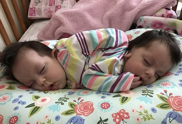 Chẩn đoán không thể sống quá 3 tháng, cặp song sinh dính liền vẫn khỏe mạnh