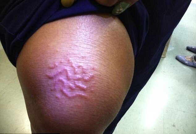 Ký sinh trùng hình giun bò lổm nhổm dưới da đầu gối người phụ nữ