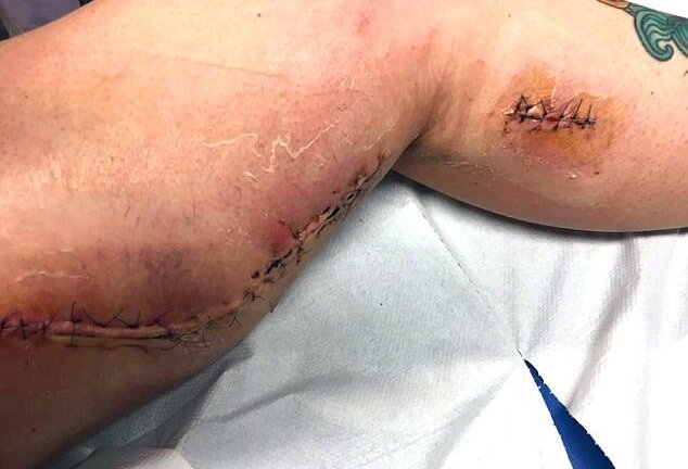 Vi khuẩn ăn thịt người 'đục' lỗ to bằng nắm tay trên chân thiếu nữ