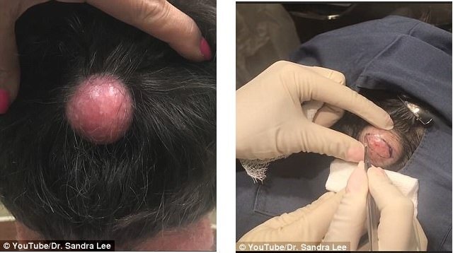 Video: Kinh hãi bác sĩ nặn u nang to như quả bóng golf từ... đầu bệnh nhân