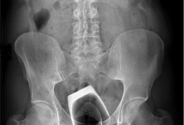Hy hữu: Hình chụp X-quang phát hiện cốc uống rượu trong hậu môn