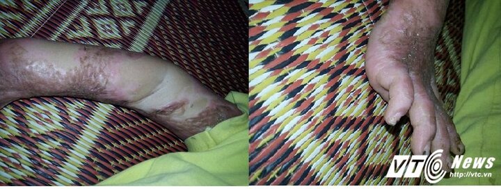 Thêm cháu bé bị thầy lang chữa bỏng không khỏi, còn lấy mất hàng chục triệu đồng?