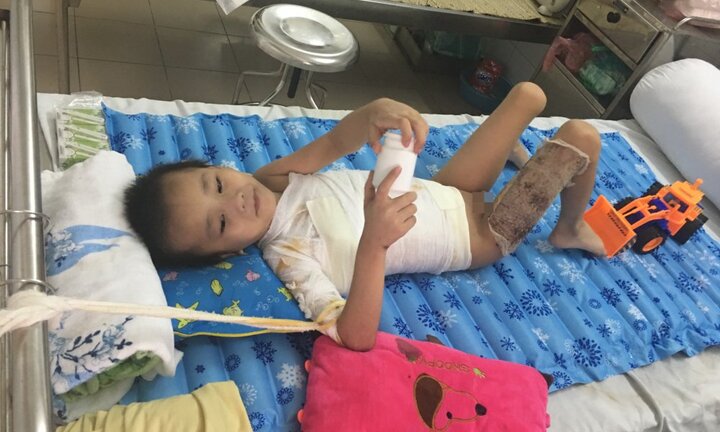 Điều trị thành công cho cháu bé chữa thuốc đông khiến cánh tay bị dính vào sườn