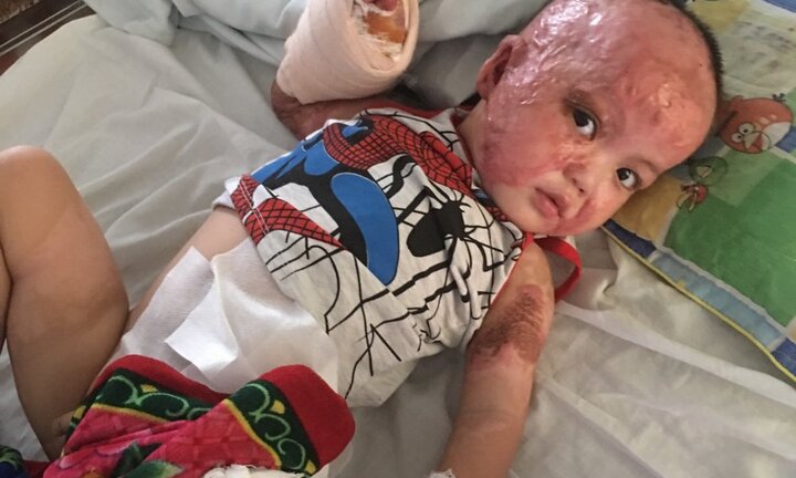 Nạn nhân tố bị 'thầy lang' chữa bỏng bất thành: Di chứng nặng nề, phải phẫu thuật nhiều lần