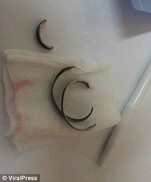 Người đàn ông Thái Lan bị mắc kẹt khi cố đeo nhẫn cho ‘của quý’